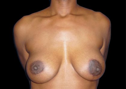Breast Augmentation Before & After Patient #1098