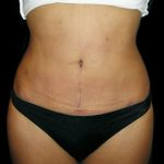 Mommy Makeover Before & After Patient #2396