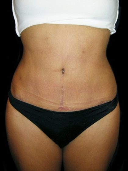 Mommy Makeover Before & After Patient #2396