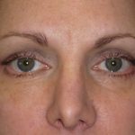 Browlift Before & After Patient #1482