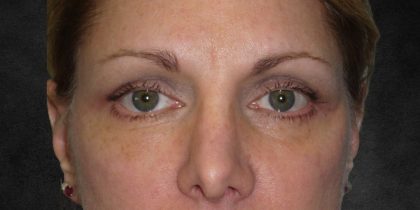 Browlift Before & After Patient #1482