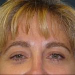 Browlift Before & After Patient #1479