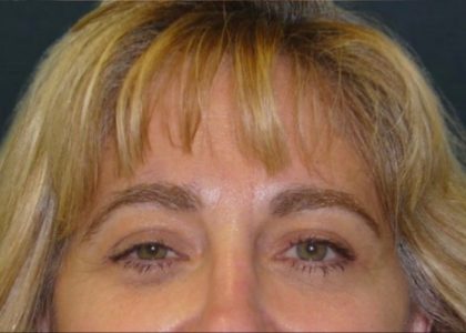 Browlift Before & After Patient #1479