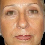 Browlift Before & After Patient #1466