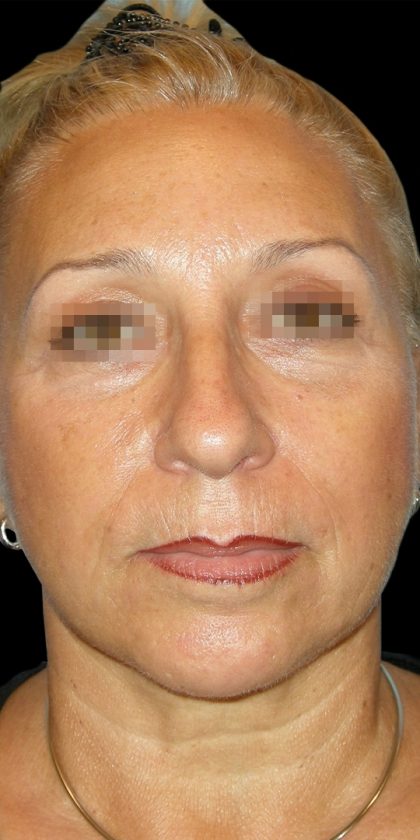 Browlift Before & After Patient #1466