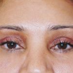 Browlift Before & After Patient #1476