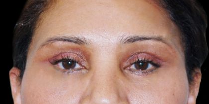 Browlift Before & After Patient #1476