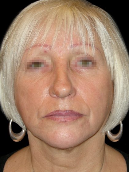 Browlift Before & After Patient #1461
