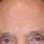 Browlift Before & After Patient #1485