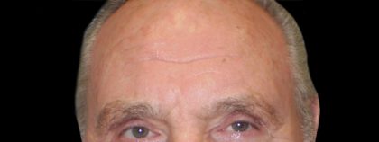 Browlift Before & After Patient #1485