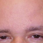 Browlift Before & After Patient #1471