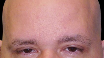 Browlift Before & After Patient #1471