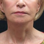 Levinelift Before & After Patient #2008
