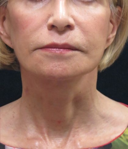 Levinelift Before & After Patient #2008