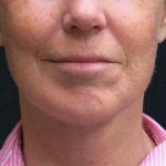 Levinelift Before & After Patient #1999