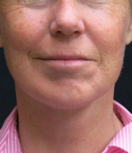 Levinelift Before & After Patient #1999