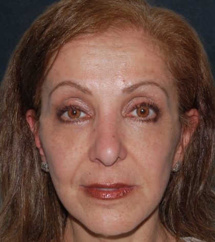 Levinelift Before & After Patient #1988