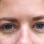 Eyelid Surgery Before & After Patient #1605