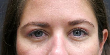 Eyelid Surgery Before & After Patient #1605