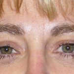 Eyelid Surgery Before & After Patient #1615