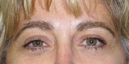 Eyelid Surgery Before & After Patient #1615