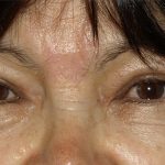 Eyelid Surgery Before & After Patient #1597