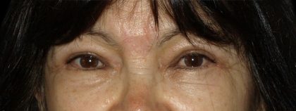 Eyelid Surgery Before & After Patient #1597