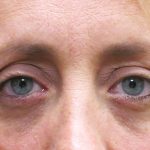 Eyelid Surgery Before & After Patient #1592