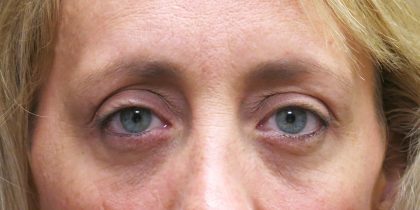 Eyelid Surgery Before & After Patient #1592