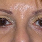 Eyelid Surgery Before & After Patient #1610