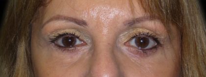 Eyelid Surgery Before & After Patient #1610