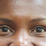 Eyelid Surgery Before & After Patient #1587