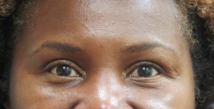 Eyelid Surgery Before & After Patient #1587