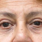 Eyelid Surgery Before & After Patient #1625