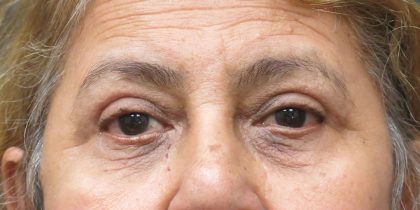 Eyelid Surgery Before & After Patient #1625