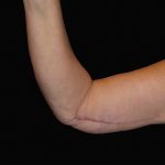 Arm Lift Before & After Patient #922