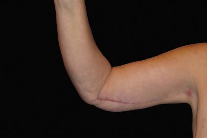 Arm Lift Before & After Patient #922