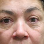 Eyelid Surgery Before & After Patient #1620