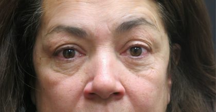 Eyelid Surgery Before & After Patient #1620
