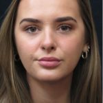Rhinoplasty Before & After Patient #2926