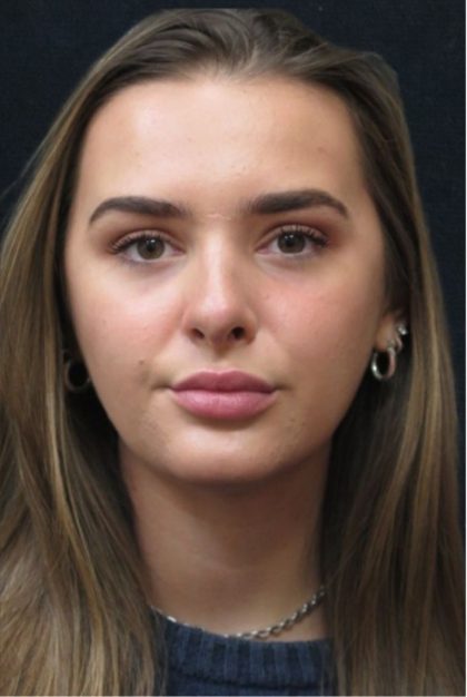 Rhinoplasty Before & After Patient #2926