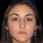 Rhinoplasty Before & After Patient #2919