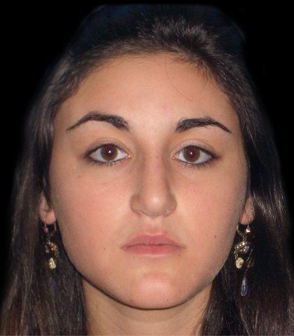 Rhinoplasty Before & After Patient #2919