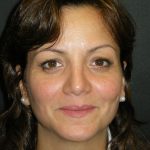 Rhinoplasty Before & After Patient #2805