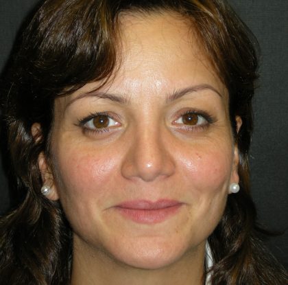 Rhinoplasty Before & After Patient #2805