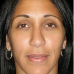 Rhinoplasty Before & After Patient #2912