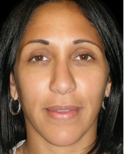 Rhinoplasty Before & After Patient #2912