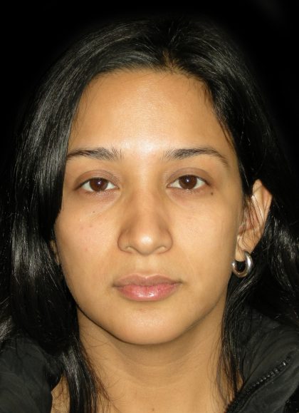 Rhinoplasty Before & After Patient #2905