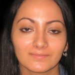 Rhinoplasty Before & After Patient #2819