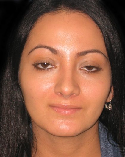 Rhinoplasty Before & After Patient #2819